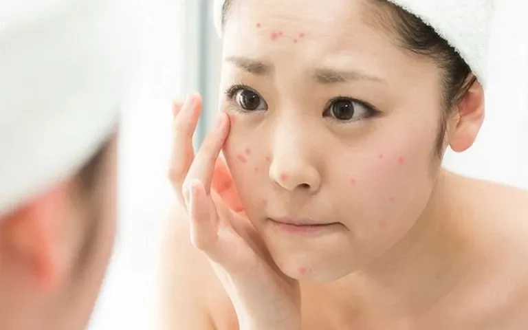 Bị mụn nội tiết nên uống vitamin gì?