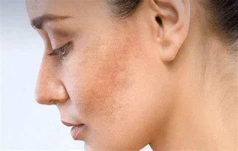 Nám nội tiết là gì?