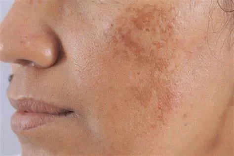 Phòng ngừa nám nội tiết: "Chủ động" bảo vệ làn da